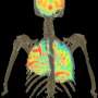 rsv patient journey