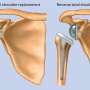 Study sheds light on the debate around two types of shoulder
replacement surgery for osteoarthritis