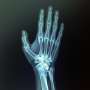 Study provides guidelines to doctors for individual treatment of wrist
fractures